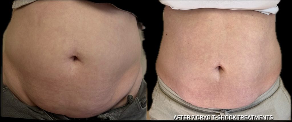 A comparison of two abdominal areas, showcasing before and after results of seven cryo t-shock treatments. The right side appears smoother and firmer than the left.
